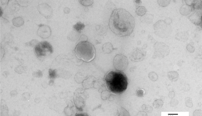 Electron Microscopy image of Microvesicles in Urine (Rachel Hurst, UEA)